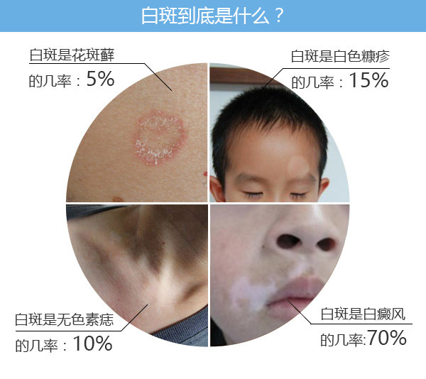 南通看白癜风到哪个医院比较好