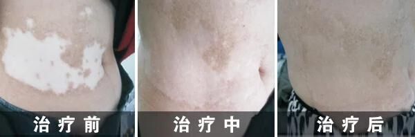 腰部出现白色皮肤是什么原因