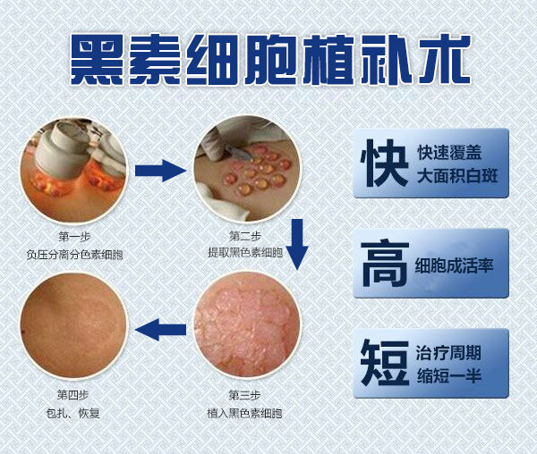 白癜风做黑色素种植手术多久能好?