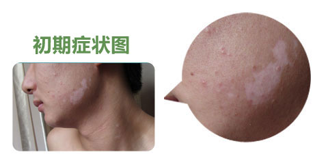 白癜风早期能治疗吗?