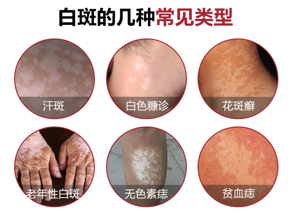 白斑病早期症状怎样分辨?