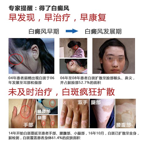 白癜风治疗要抓住时机