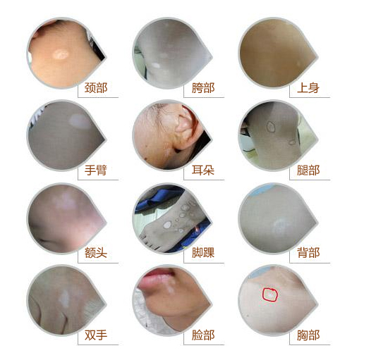 胸前的一小点白斑不治会怎样