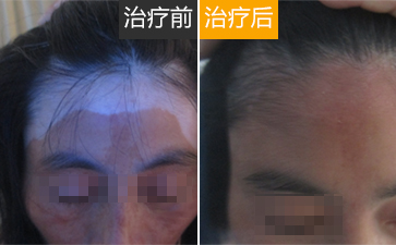 白癜风白斑部位脱皮是怎么回事
