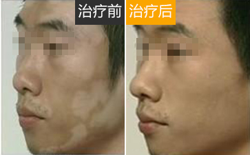 男性怎么预防白癜风的出现?
