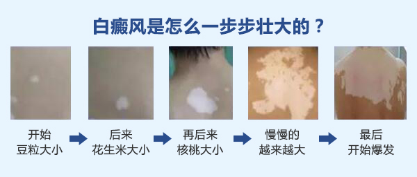 哪些人更容易得白癜风?