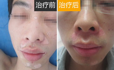 怎么避免青少年白癜风的产生