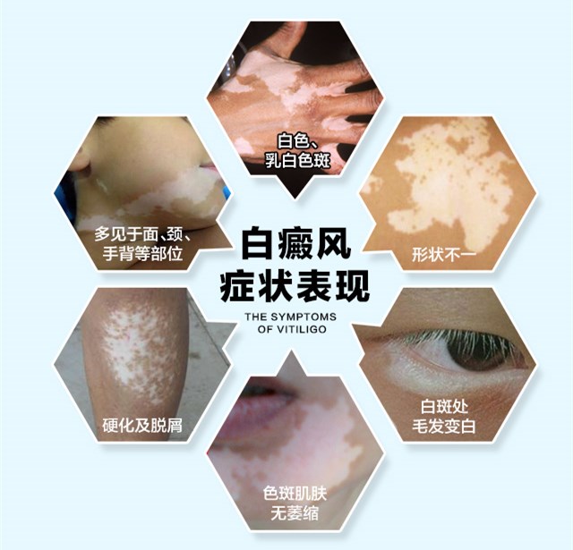白癜风的常发部位以及检查方法
