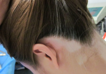 情绪不良会加重白癜风吗