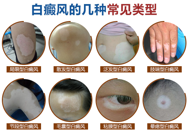 白癜风疾病的基本常识有什么