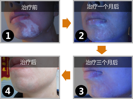 白癜风多久能够治疗