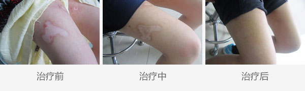 腿部白斑八年在复大治疗