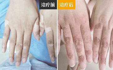 手上长了很大面积的白癜风怎么