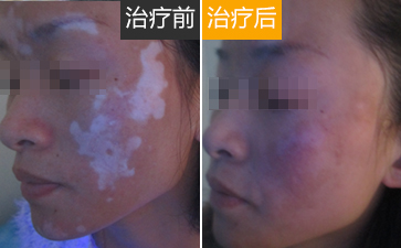 白癜风治疗之前需要患者做哪些