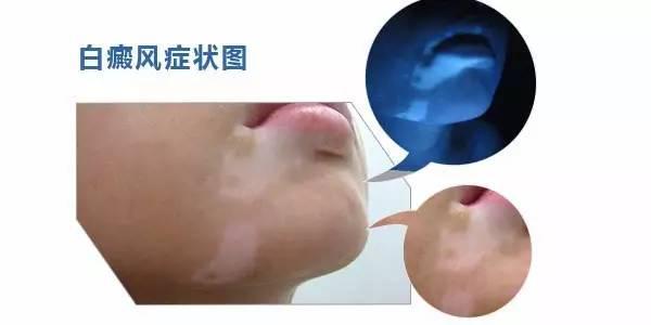脸部白癜风怎么治疗恢复更快呢