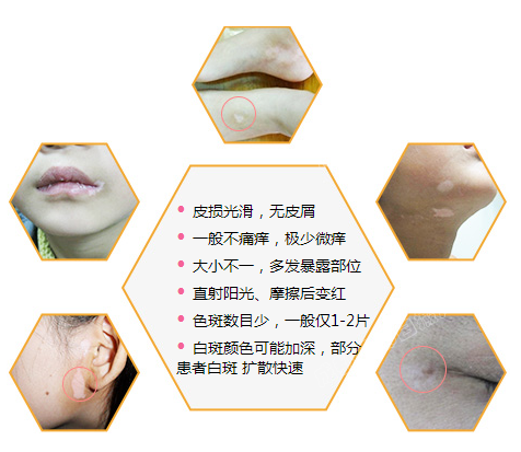 白癜风扩散后的症状有哪些呢？