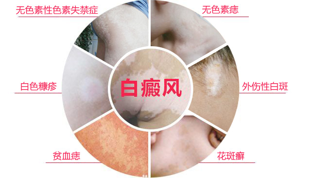 引起女性白癜风的原因是什么？