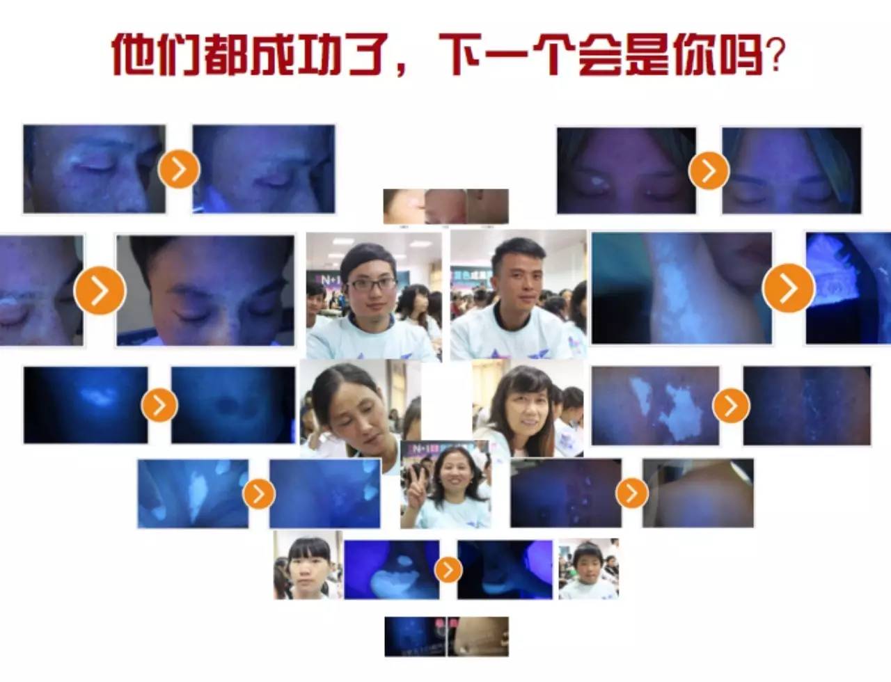 　南通病人治疗白癜风要多做一些护理工作