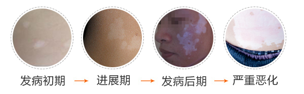 腰上小面积白癜风怎么治?