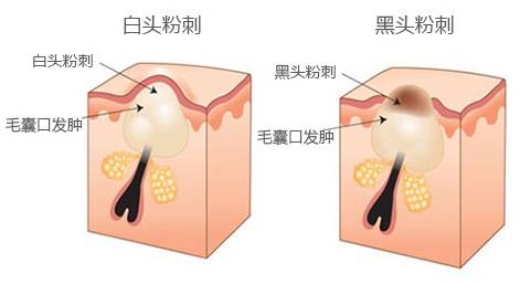 痤疮出现的原因是什么？