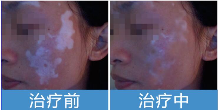 白癜风在生活中该怎么诊断呢