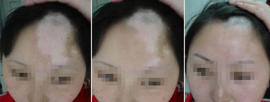 女性白癜风疾病的具体诱因?