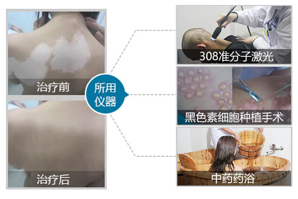 白癫风中西医治疗 患者要选择合