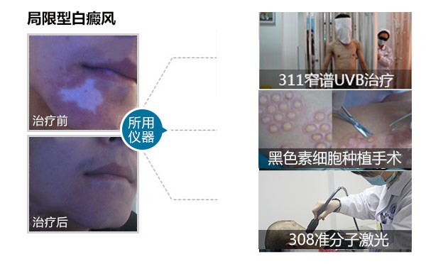 什么是局部性白癜风又该如何治