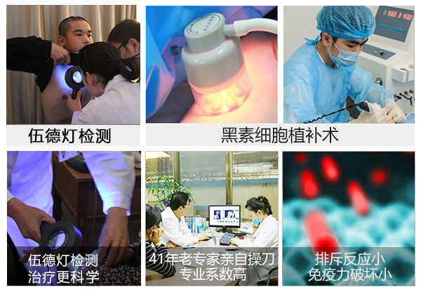 背部白癜风可以治疗吗?