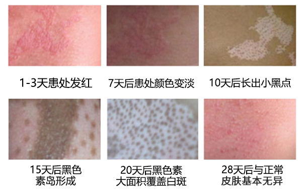 白癜风的好转表现是什么样的