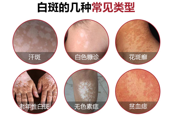 女子白癜风的症状都是什么