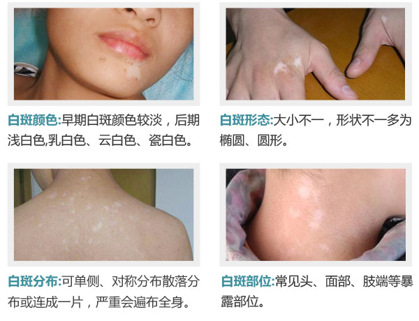 白癜风患者冬季如何选择衣物？