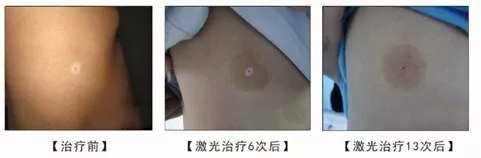 白癜风患者能做蒸汽浴吗？