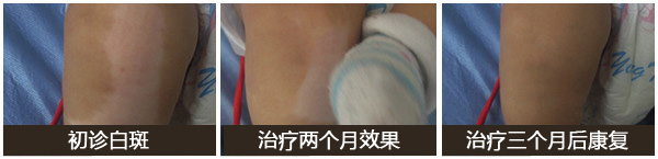 进展期白癜风如何快速控制病情？治疗重点是什么