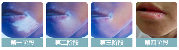 白癜风和色素脱失有什么不同呢?
