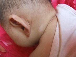 婴儿白癜风初期症状有哪些呢?