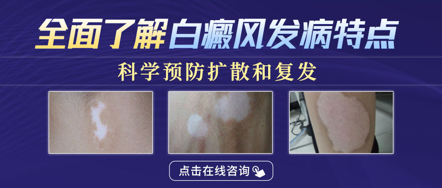 　如何科学治疗节段型白癜风