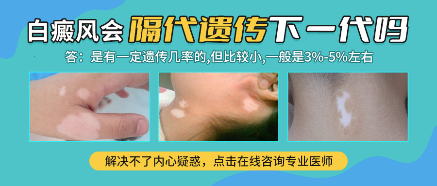 　​白癜风遗传的四大典型表现　　
