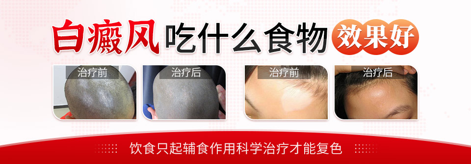 加速白癜风调治的三大科学策略
