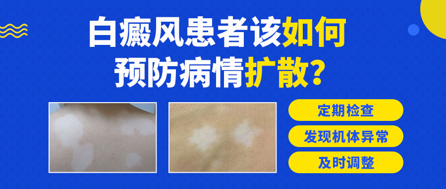 　​儿童白癜风：科学预防扩散指南​
