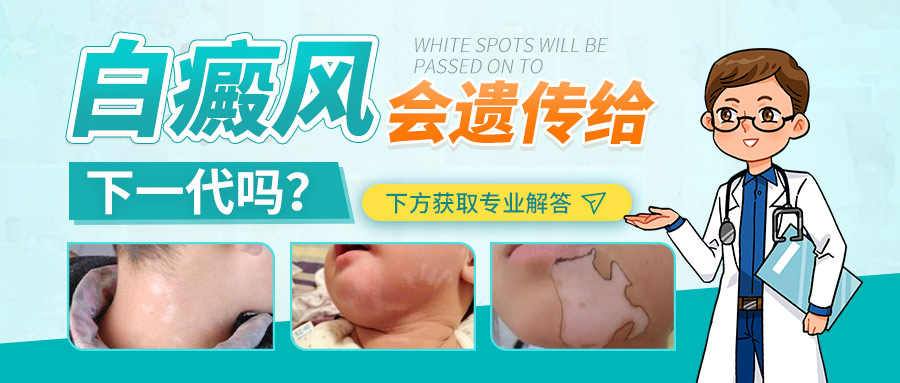 ​白癜风会遗传给孩子吗