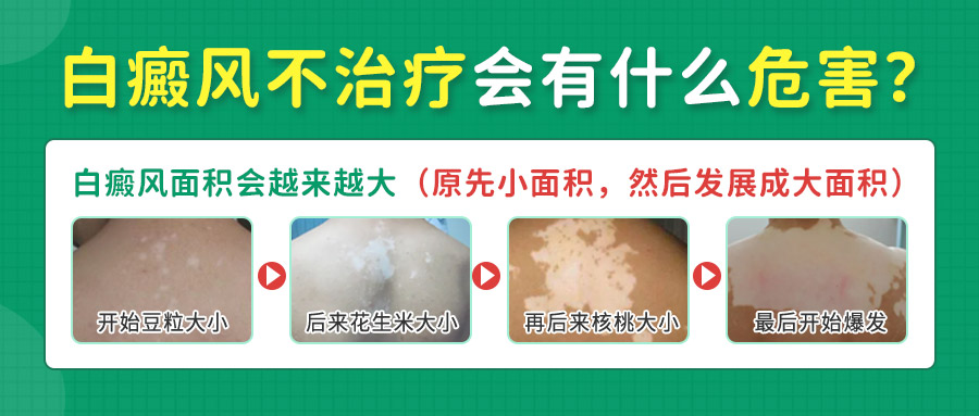 局限性白癜风的症状解析​