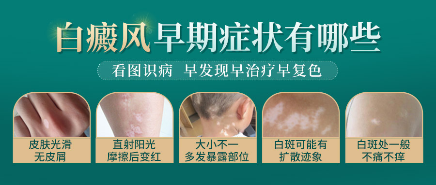 　白癜风早治疗四大核心益处